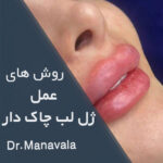 روش های مختلف عمل ژل لب چاک دار